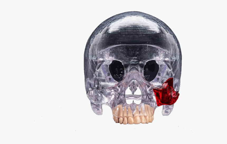 3d Printed Head Skull Transparent Surgical Guide - 3d Printing, HD Png Download, Free Download