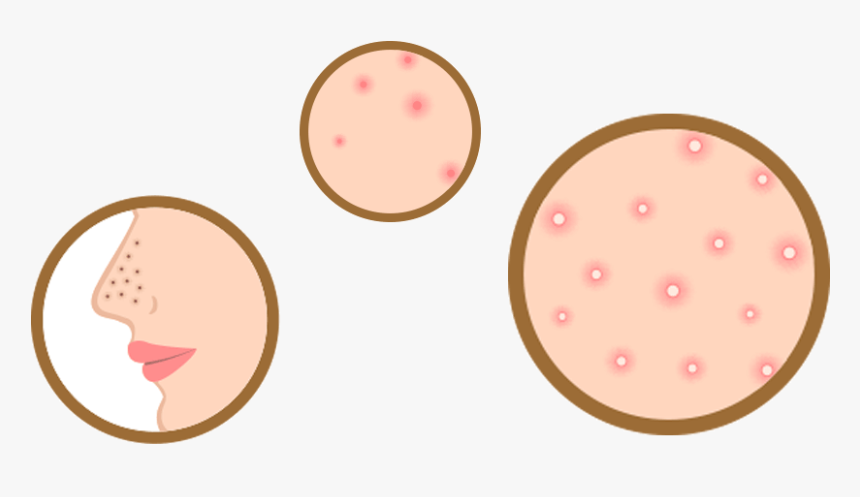 Acne , Png Download - Circle, Transparent Png, Free Download