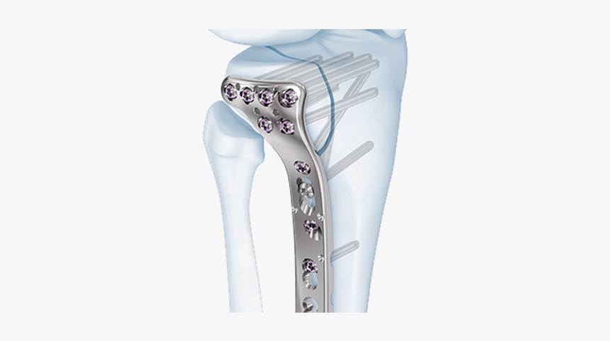 Proximal Tibial Locking Plate, HD Png Download, Free Download