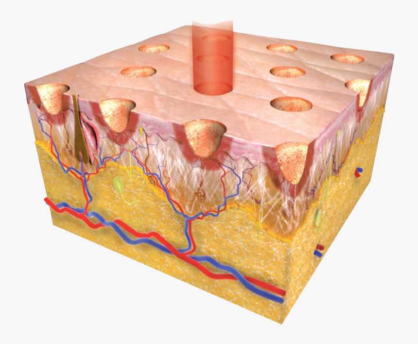 Fractional Co2 Laser, HD Png Download, Free Download