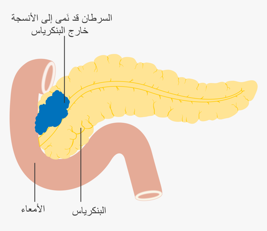 Cancer De Pancreas Png , Png Download - Pancreas In Arabic, Transparent Png, Free Download