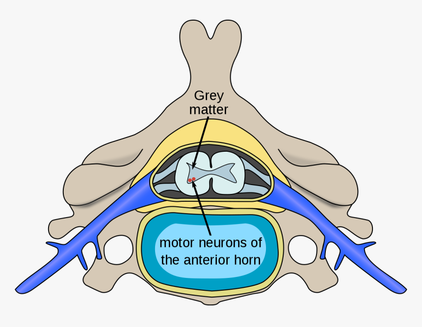 Acute Flaccid Myelitis Anterior Horn, HD Png Download, Free Download