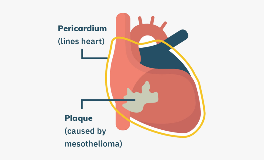 Pericardial Mesothelioma, HD Png Download, Free Download