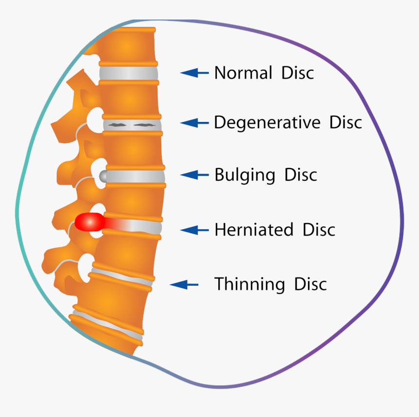 Herniated Disc Physical Therapy, HD Png Download, Free Download