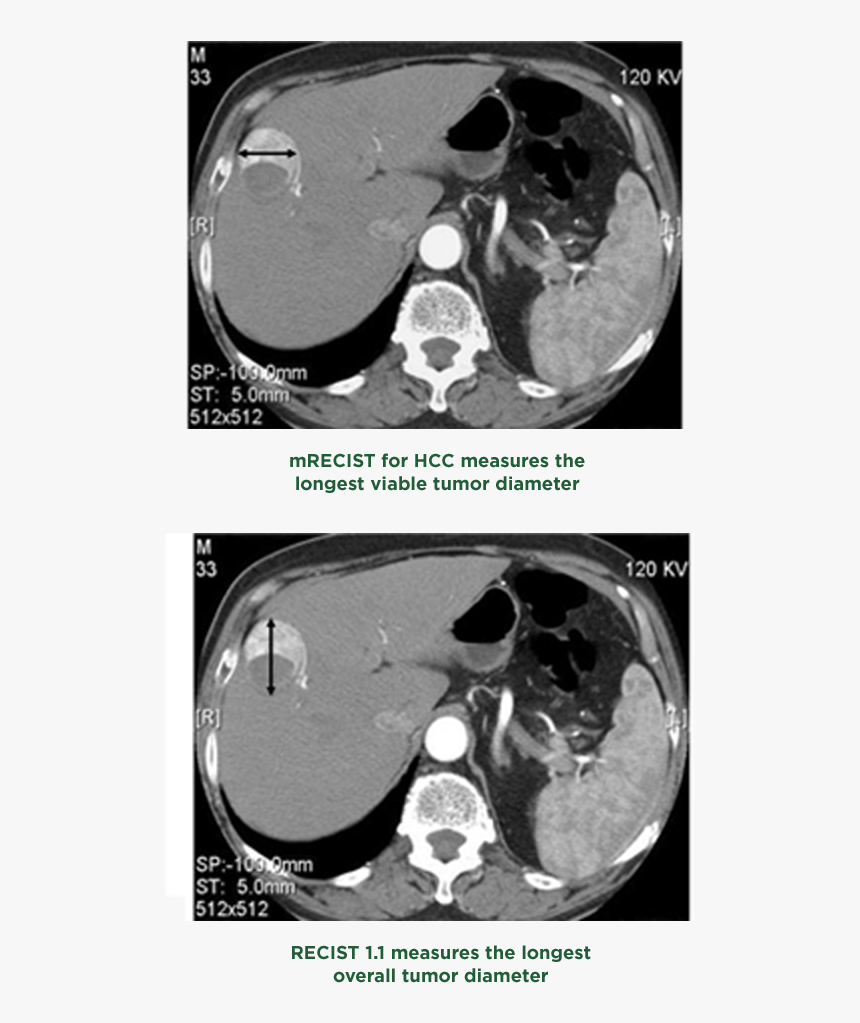 Mrecist Recist Img - Computed Tomography, HD Png Download, Free Download