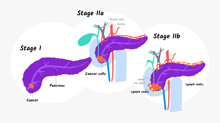 Illustration Of Stage I And Stage Iia And Iib Pancreatic - Stage 1 Early Stage Pancreatic Cancer, HD Png Download, Free Download