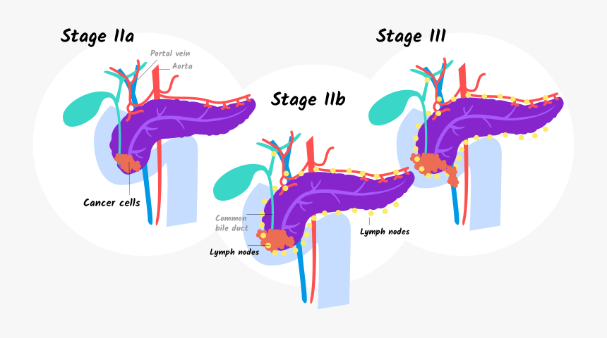 Illustration Of Stage Iia, Iib, And Stage Iii Pancreatic - Cancer Of Pancreas Stage 4, HD Png Download, Free Download