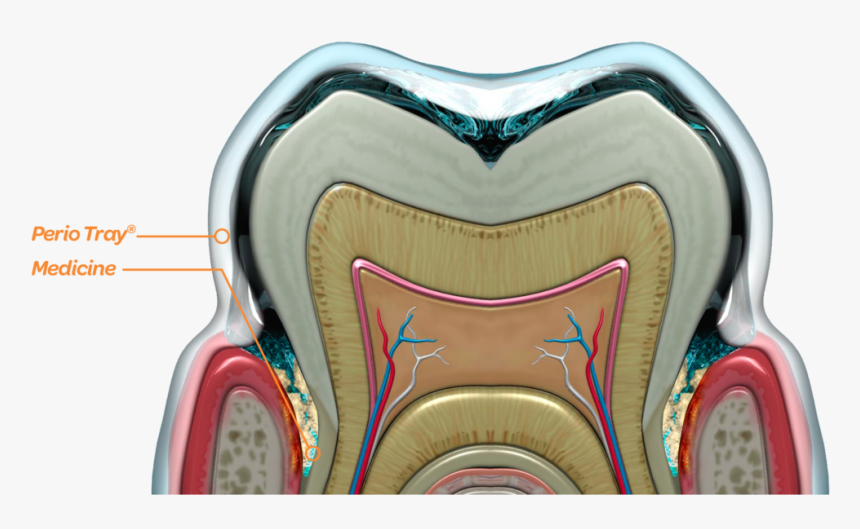 Periodontal Pocket Cross Section, HD Png Download, Free Download