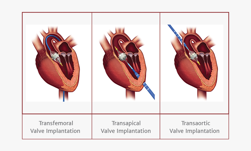 Aortic Stenosis New Treatment Options - Transcatheter Aortic Valve Replacement, HD Png Download, Free Download