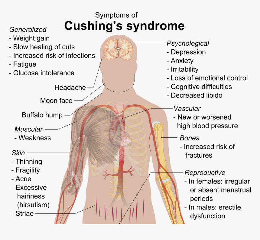 Cushing"s Syndrome - Cushing's Syndrome Addison's Disease, HD Png Download, Free Download