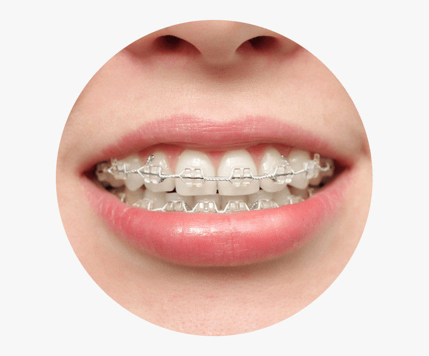 Transparent Rubber Braces, HD Png Download, Free Download