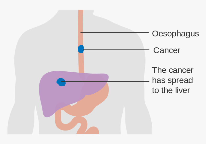 Countries With The Highest Rates Of Esophageal Cancer - Esophageal Cancer Png, Transparent Png, Free Download