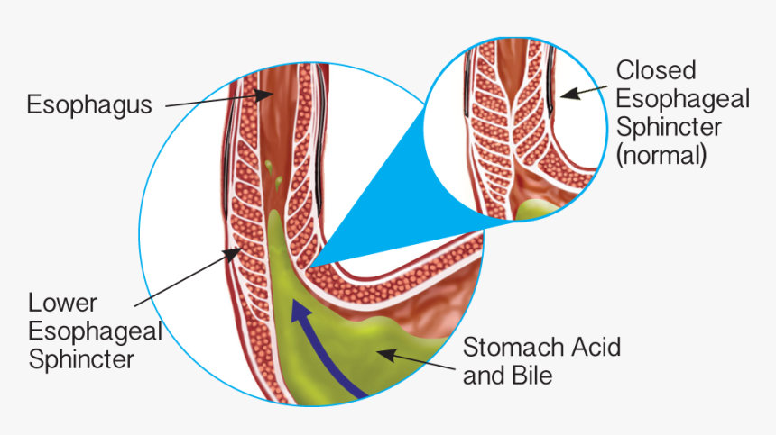 Transparent Esophagus Png - Esophageal Sphincter Linx, Png Download, Free Download