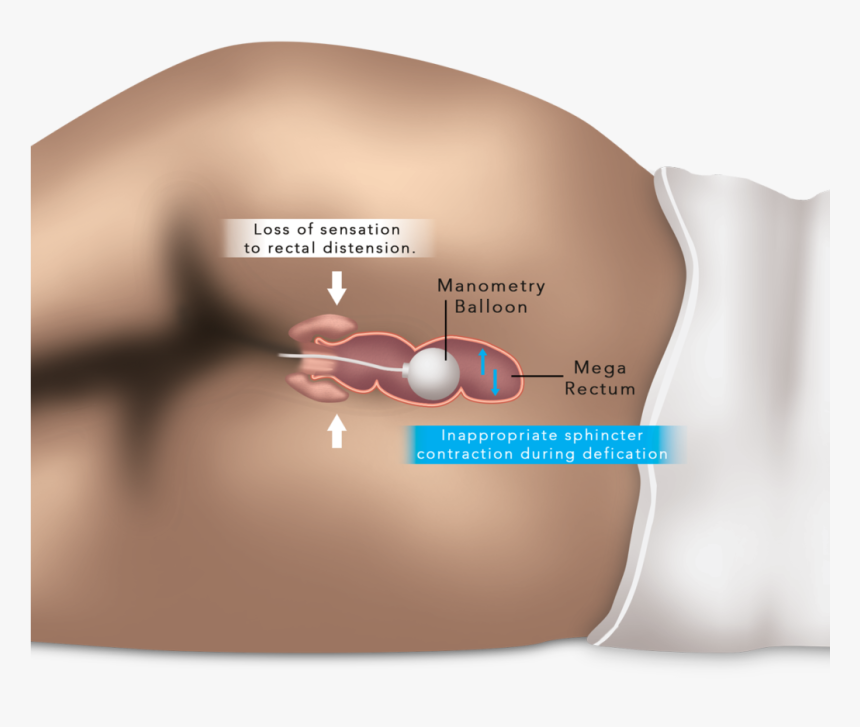 Esophageal And Anorectal Manometry - Anorectal Manometry, HD Png Download, Free Download