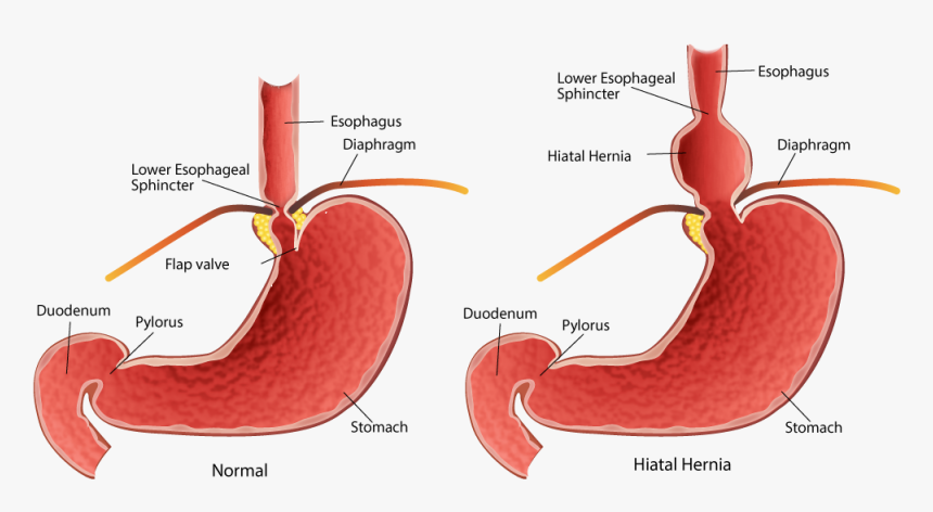 Minor Hiatal Hernia, HD Png Download, Free Download